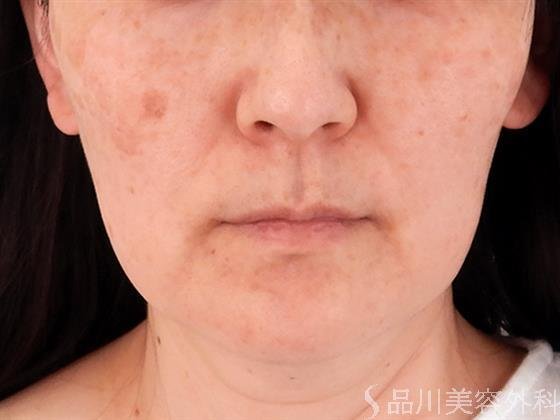 症例NO.60218のBEFORE写真