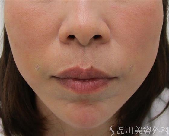 症例NO.43140のAFTER写真