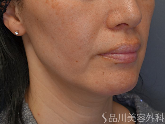 症例NO.69677のBEFORE写真