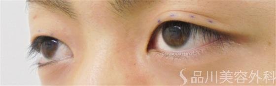症例NO.23697のBEFORE写真