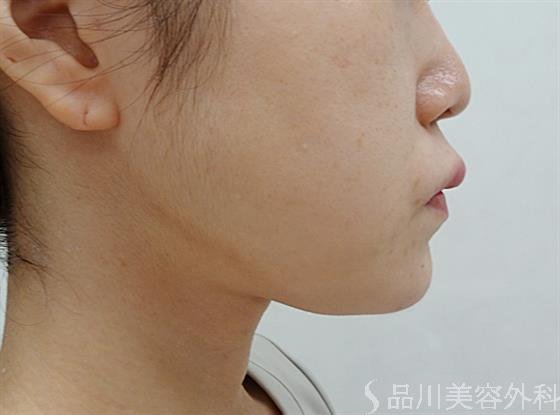 症例NO.51373のAFTER写真