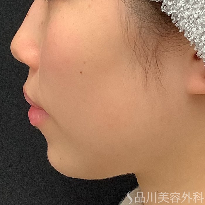 症例NO.69642のAFTER写真