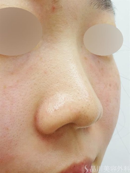 症例NO.39670のBEFORE写真