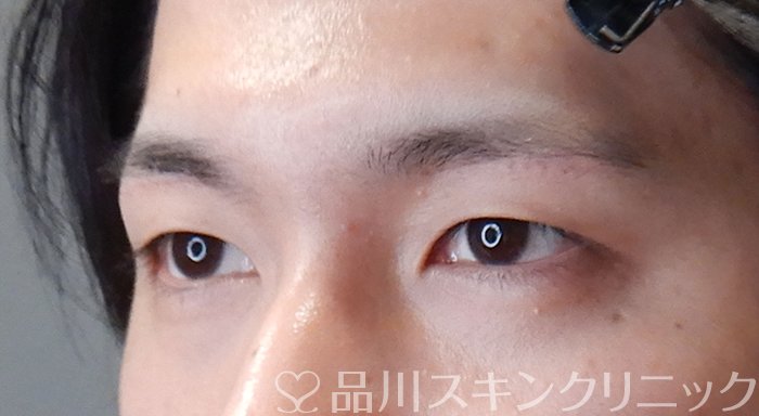 症例NO.70659のAFTER写真