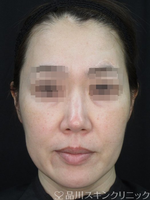 症例NO.73486のAFTER写真