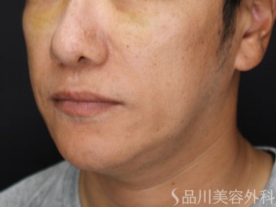 症例NO.72871のBEFORE写真