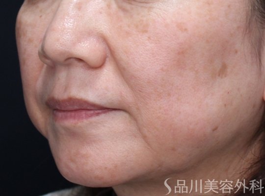 症例NO.72706のBEFORE写真