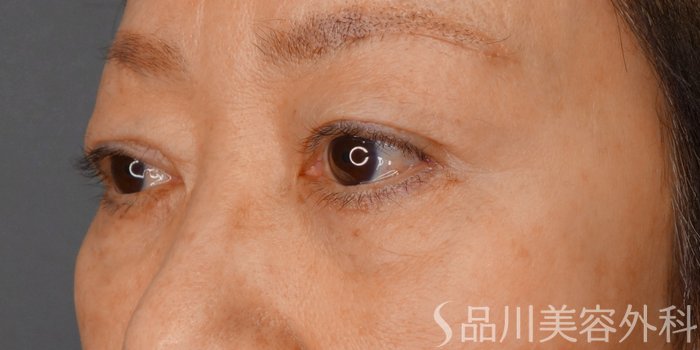 症例NO.73222のAFTER写真