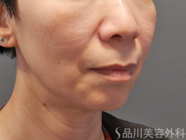 症例NO.74312のBEFORE写真