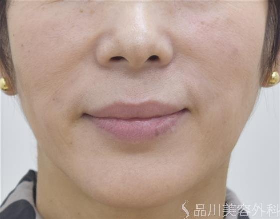 症例NO.45358のAFTER写真