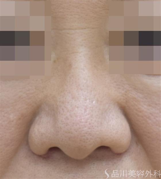 症例NO.45239のAFTER写真