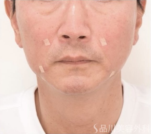 症例NO.71666のAFTER写真