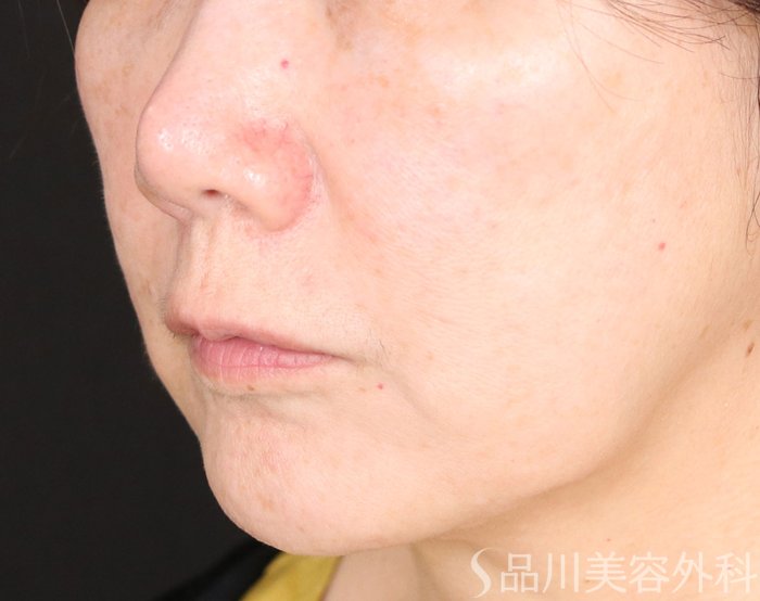 症例NO.71022のBEFORE写真