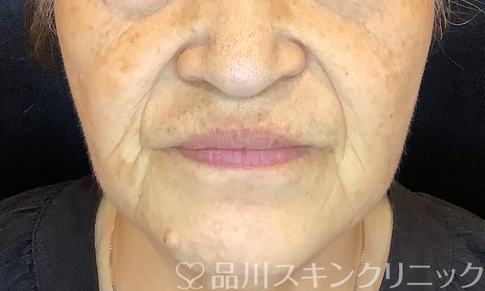 症例NO.75388のBEFORE写真
