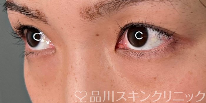 症例NO.70040のBEFORE写真