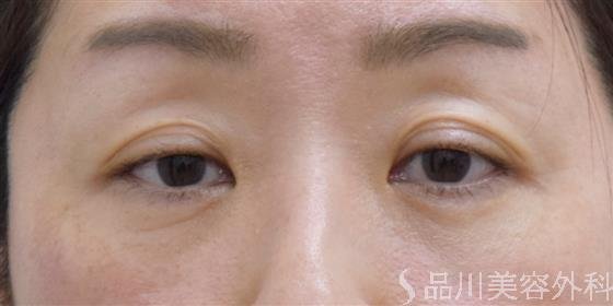 症例NO.61140のAFTER写真