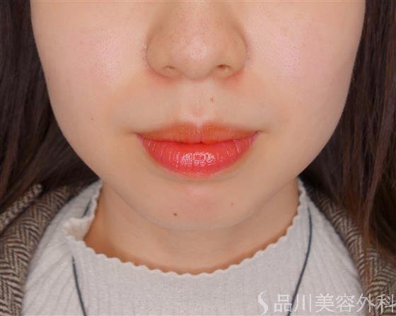 症例NO.52958のBEFORE写真