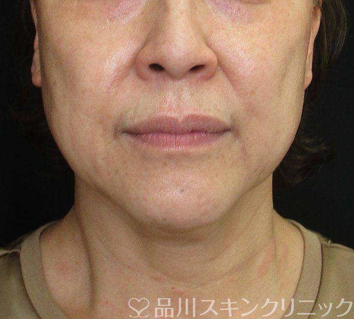 症例NO.74974のBEFORE写真