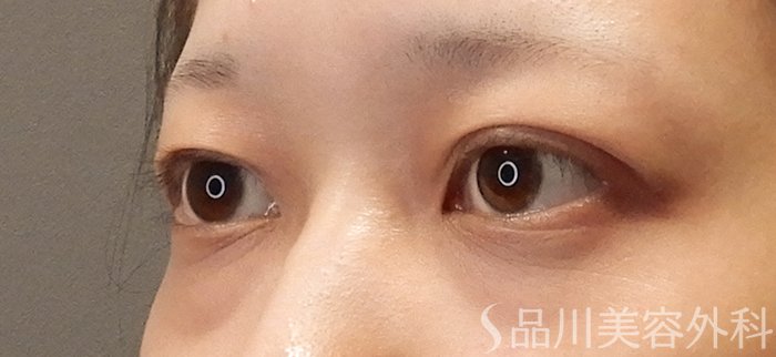 症例NO.71450のBEFORE写真