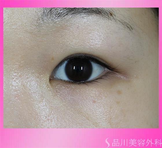 症例NO.52658のAFTER写真