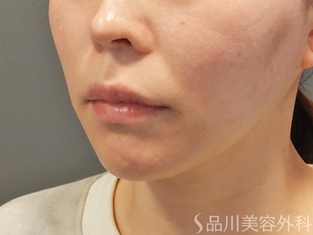症例NO.73780のAFTER写真