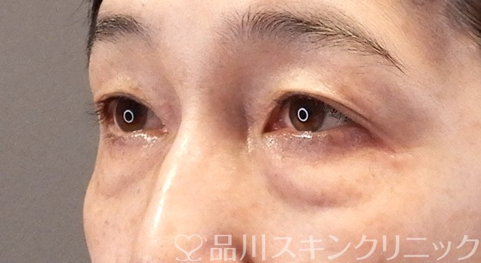 症例NO.64331のBEFORE写真