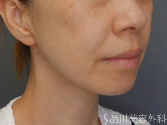 症例NO.71453のBEFORE写真