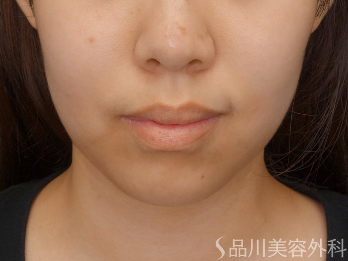 症例NO.71603のBEFORE写真