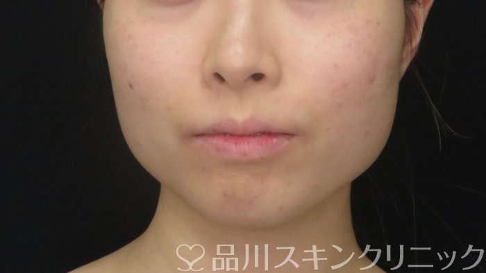 症例NO.72287のBEFORE写真