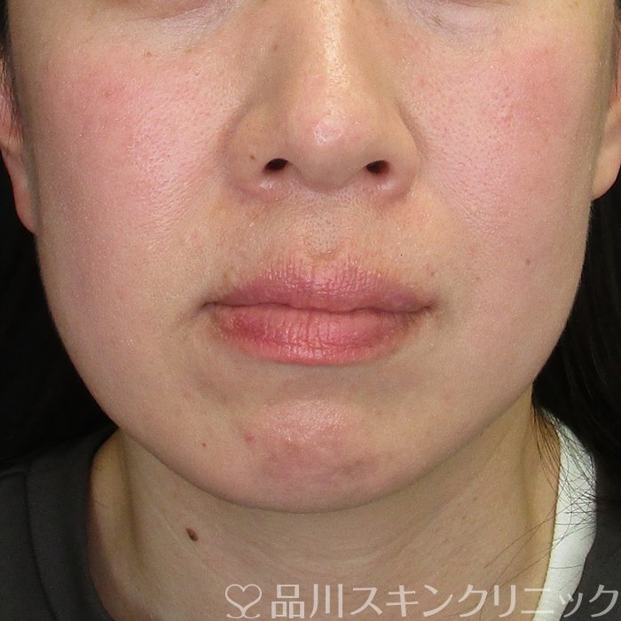 症例NO.73765のBEFORE写真