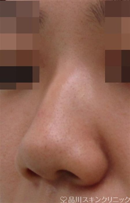 症例NO.38026のBEFORE写真