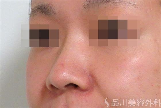 症例NO.35704のBEFORE写真