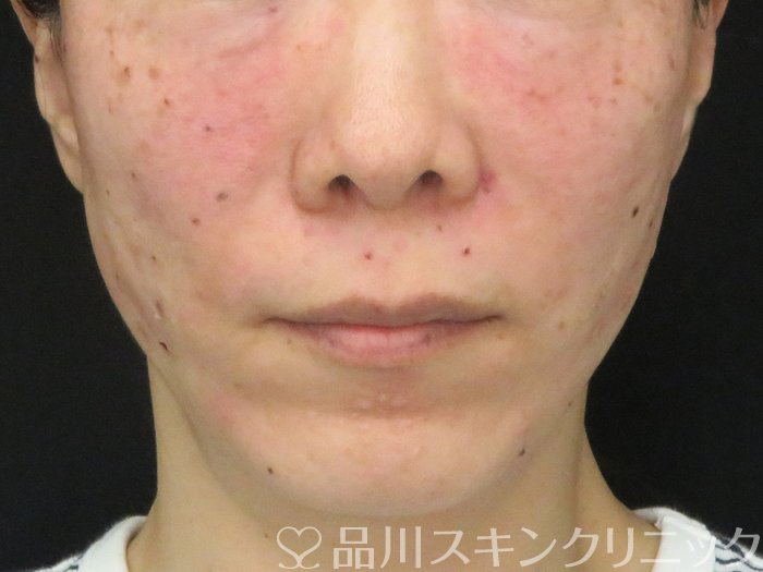 症例NO.69754のAFTER写真
