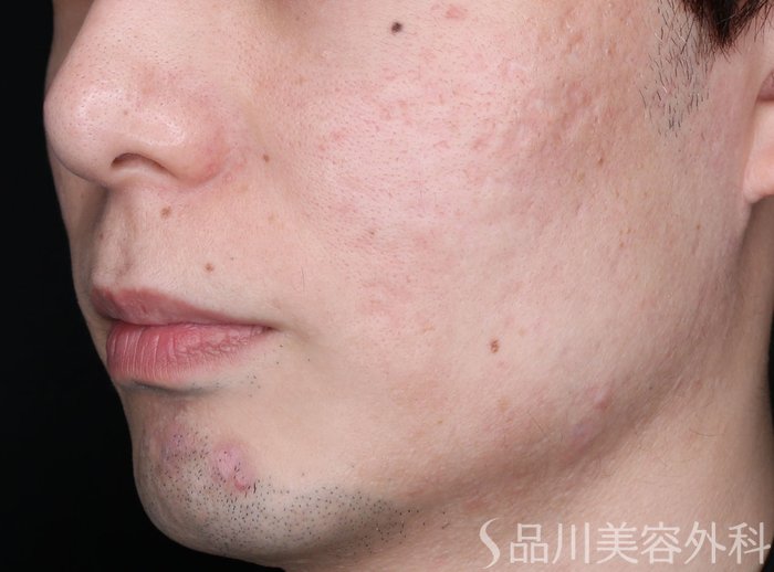 症例NO.65280のBEFORE写真