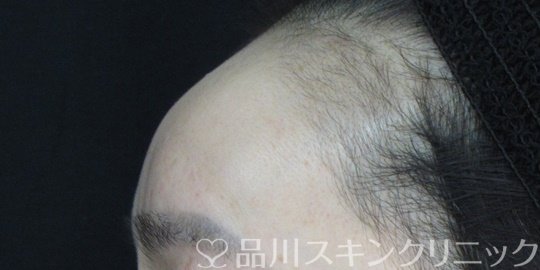 症例NO.74829のAFTER写真