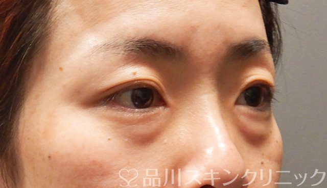 症例NO.68167のBEFORE写真