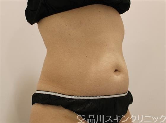 症例NO.48166のBEFORE写真