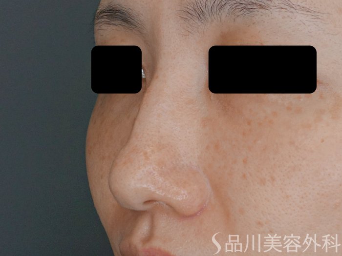 症例NO.71511のBEFORE写真