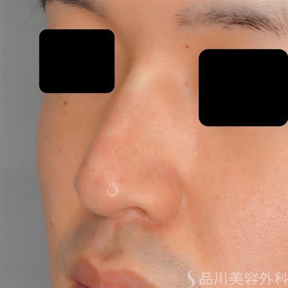 症例NO.53702のAFTER写真