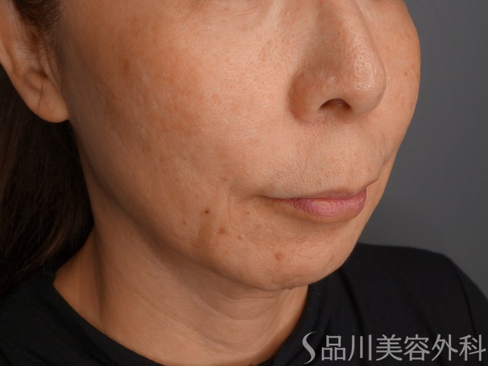 症例NO.74396のBEFORE写真