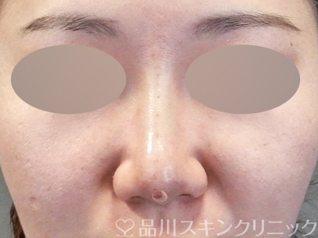症例NO.64674のAFTER写真