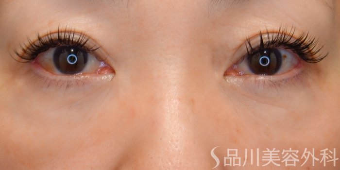 症例NO.71786のAFTER写真