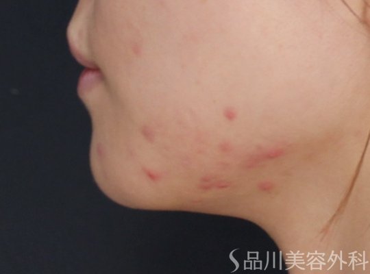 症例NO.71271のBEFORE写真