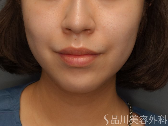 症例NO.74928のBEFORE写真