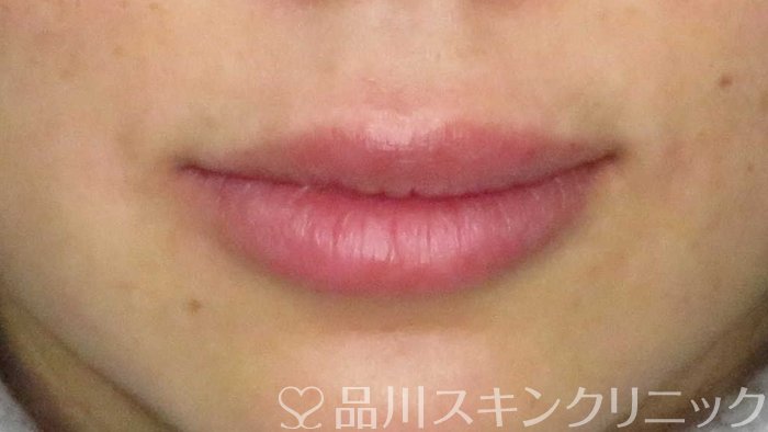 症例NO.65533のAFTER写真
