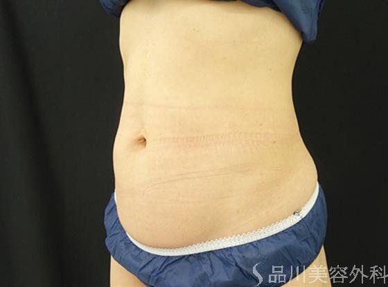 症例NO.44767のBEFORE写真