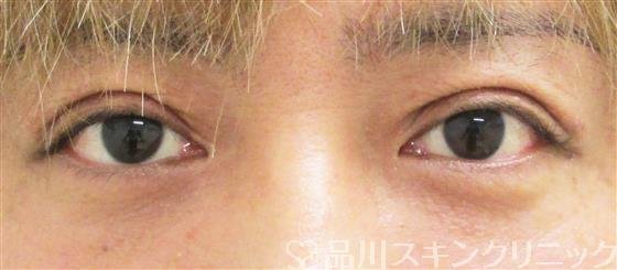 症例NO.44011のAFTER写真