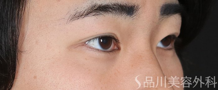 症例NO.73084のAFTER写真