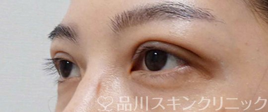 症例NO.65256のAFTER写真