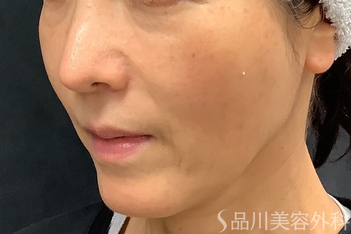 症例NO.71248のBEFORE写真